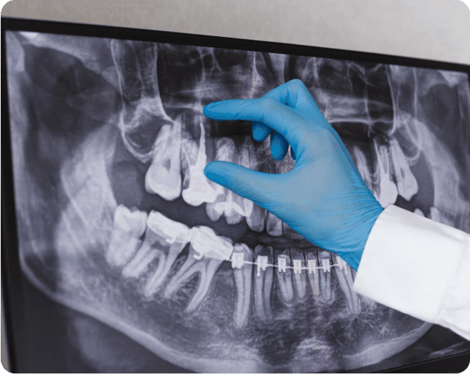 Root Canal Treatment